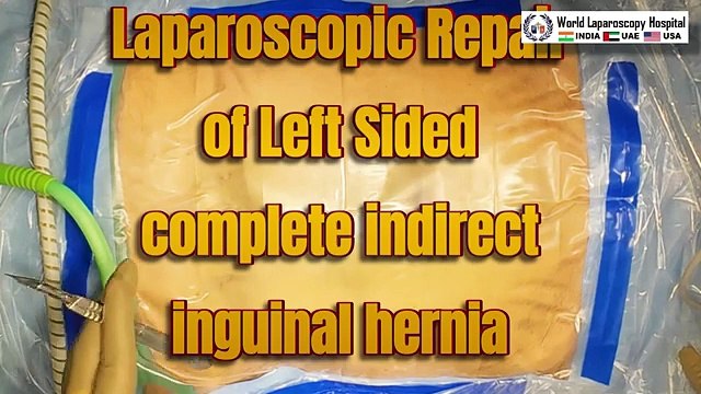 Laparoscopic Repair of Left-Sided Complete Indirect Inguinal Hernia Skin to Skin Surgery Video
