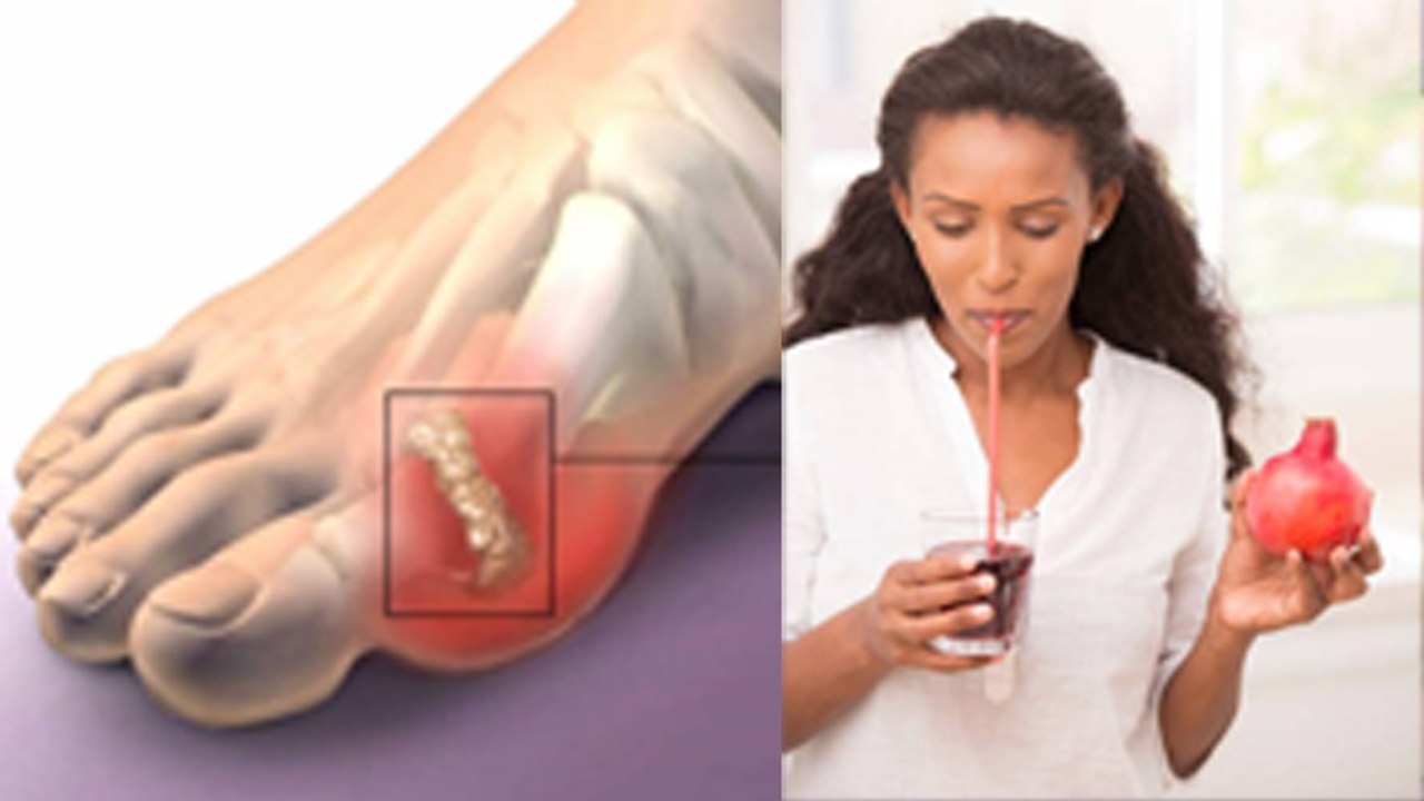 यूरिक एसिड में अनार का जूस पीना चाहिए या नहीं | Does Pomegranate Have High Uric Acid | Boldsky