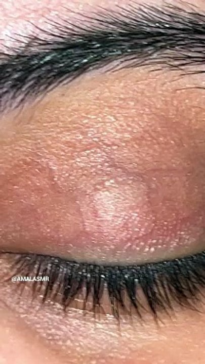 Eye