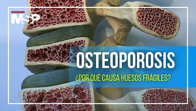 Osteoporosis: ¿Por qué causa huesos frágiles?
