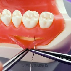 Suture & Stitching Techniques - An Overview