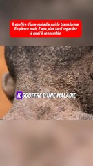 Il souffre d’une maladie rare