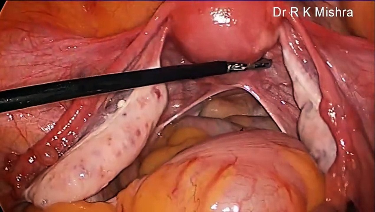 Lap and Dye Test (Laparoscopic Tubal Patency Test)