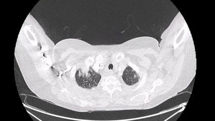 Oncohématologie CC n°2 MIR Nice