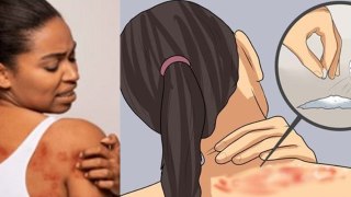 Heat Rash Treatment: Ghamori Ka Gharelu Upay | घमौरी कैसे ठीक करें | Boldsky