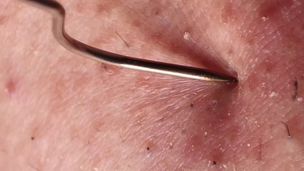 Retirer les poils incarnés à l'aide d'une pince à épiler / Pull out ingrown hairs with tweezers