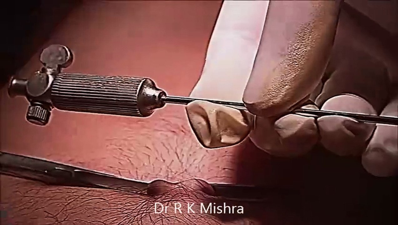 Laparoscopic Access Technique using Veress Needle