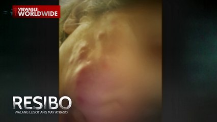 Isang ginang, nasira ang mukha dahil sa mga treatment ng 'di lisensyadong  dermatologist?! | Resibo