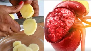 Daily Potato Khane Se Kidney Damage Hota Hai Kya, High Potassium Foods To Avoid..|Boldsky