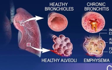 RV and Respiratory Problems