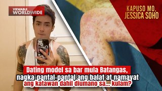 Dating model sa bar, nagkapantal-pantal ang katawan dahil umano sa kulam?! | Kapuso Mo, Jessica Soho