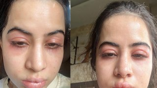 Urfi Javed Face Swollen After Allergy Emotional Post Viral, Fans Shocking Reaction Viral | Boldsky