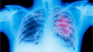 Lungenkrebsforschung: Studie ermittelt Behandlung für bessere Lebenserwartung