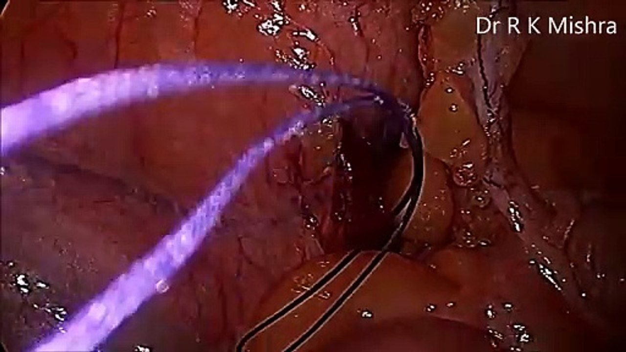 Laparoscopic Appendectomy by Dr. R. K. Mishra