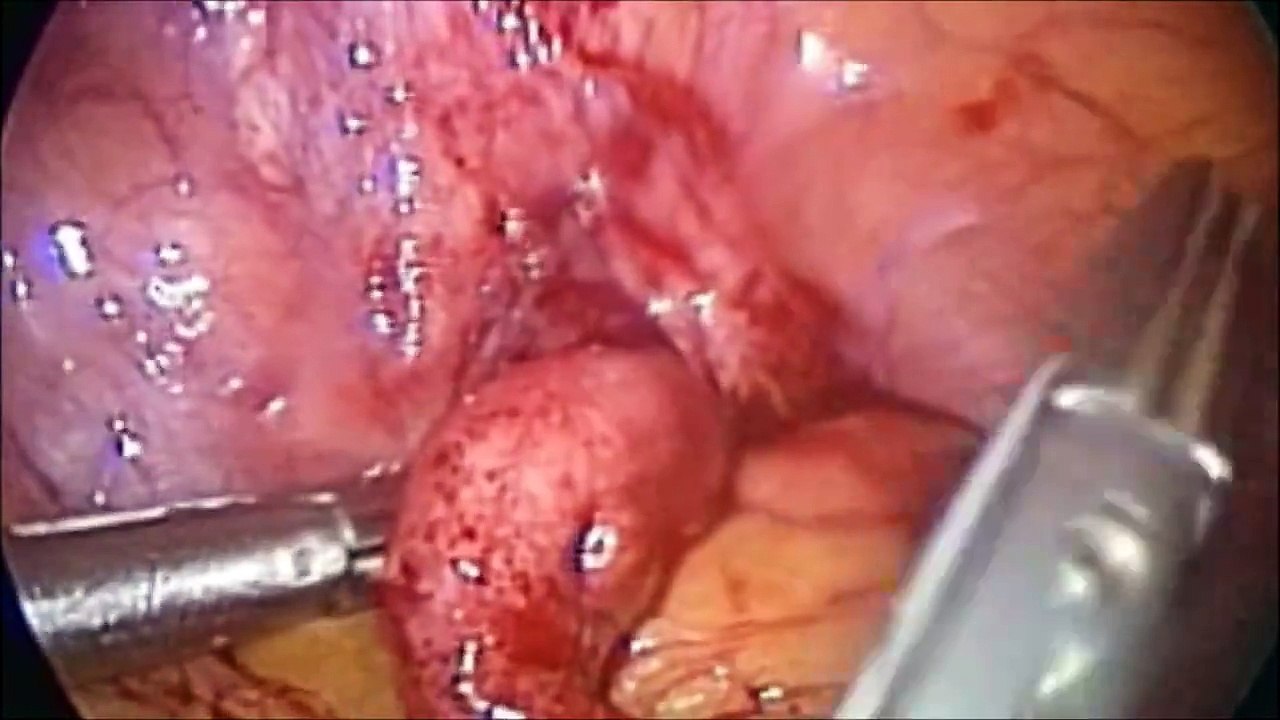 Laparoscopic Appendectomy for Acute Appendicitis