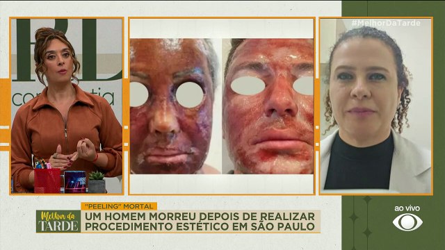 Peeling de fenol: saiba os riscos e os cuidados |Melhor da Tarde
