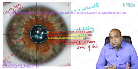 Middle layer of eye horners syndrome accompdation with anomaly