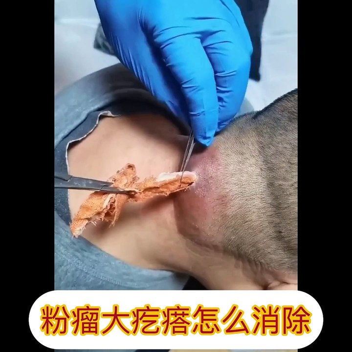 health | 粉瘤大疙瘩怎么消除