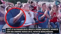 ¿Qué le ha pasado en el brazo a Pedro Sánchez? Aparece con una enorme herida en el mitin de Benalmádena