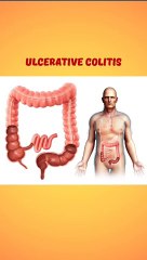 अल्सरेटिव कोलाइटिस क्या होता है || अल्सरेटिव कोलाइटिस के लक्षण || अल्सरेटिव कोलाइटिस होने के कारण |