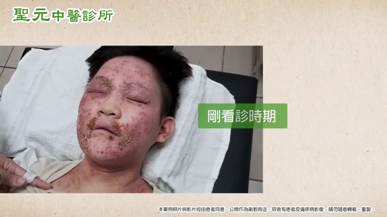 異位性皮膚炎治療過程｜聖元中醫診所｜NOW健康
