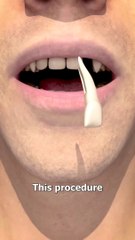 Tooth In Eye Surgery  (explained)