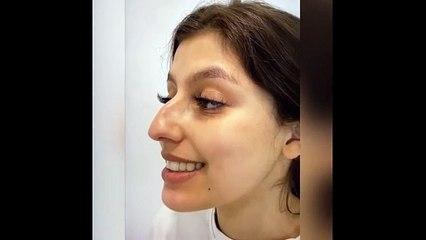 Sadece burun estetiği ile yeni biri oldu