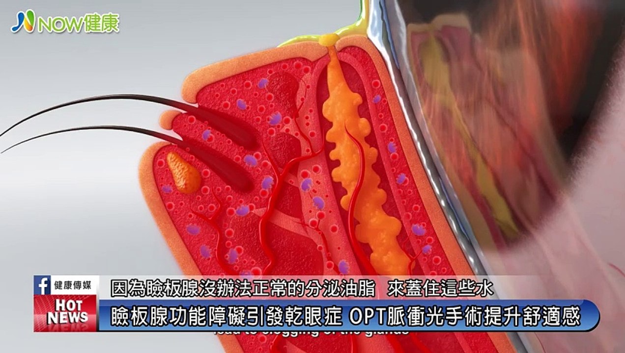 近視雷射恐引發乾眼症 與瞼板腺功能障礙有關｜德昌眼科診所 - 新聞影片｜遠大整合行銷
