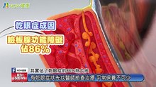 脈衝光不只用來改善皮膚問題 還可以治療缺油型乾眼症｜恩主公醫院 - 新聞影片｜遠大整合行銷
