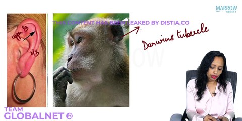 Clinical embryology of external ear ENT