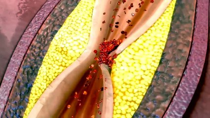 Recognizing a heart attack  3D Animation