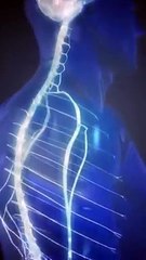 Cuidado con el síndrome de Guillain-Barré; esto es lo que sabemos