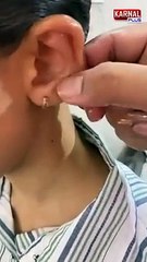 Ear points to treat medically