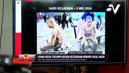 Kecederaan akibat disimbah asid dialami Faisal Halim menunjukkan perkembangan positif daripada segi pemulihan