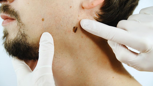 bd-cancer-de-piel-claves-para-una-deteccion-temprana-130624