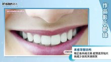 矯正後內縮泛黃 超薄瓷牙貼片完成少女的天使微笑｜禾睿牙醫診所 - 作品節錄｜遠大整合行銷
