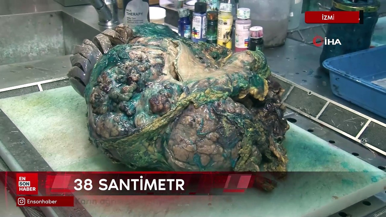 Karın ağrısı şikayetiyle gitti, karnından 10 kilo dev tümör çıkartıldı