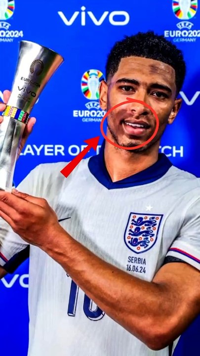  Mais qu’est qu’a Jude Bellingham sur le visage ? Unique buteur contre la serbie à l’Euro 2024, l’anglais a aussi attiré l’attention du public avec cette tâche sur le visage qui est en réalité du melasma. #bellingham #euro2024 #melasma