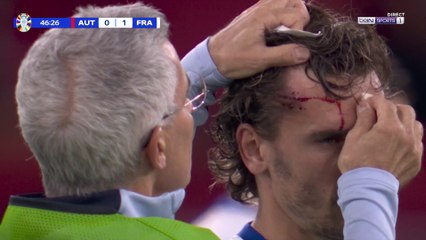 Euro 2024 : Griezmann Blessé avec le Visage en Sang ⚽
