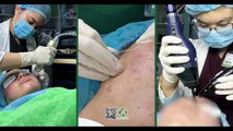 Cách chăm sóc da sau điều trị sẹo rỗ từ Bác sĩ Da liễu
