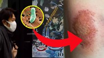 Flesh Eating Bacteria Japan Outbreak: 48 Hours में निधन, Symptoms & Treatment | Boldsky