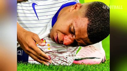Kylian Mbappé's nose injury