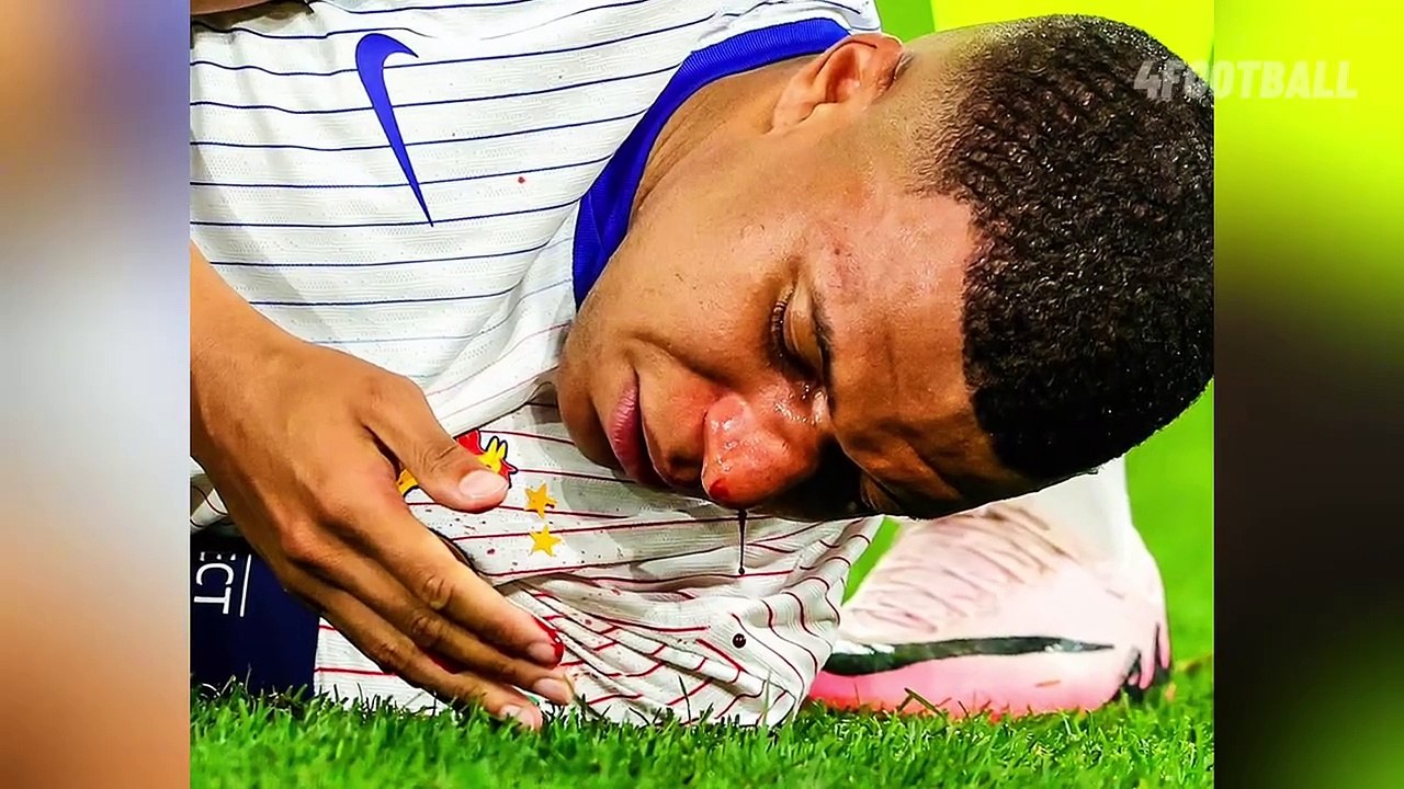 Kylian Mbappé's nose injury