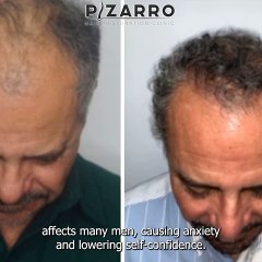 Can You Regrow Male Pattern Baldness?