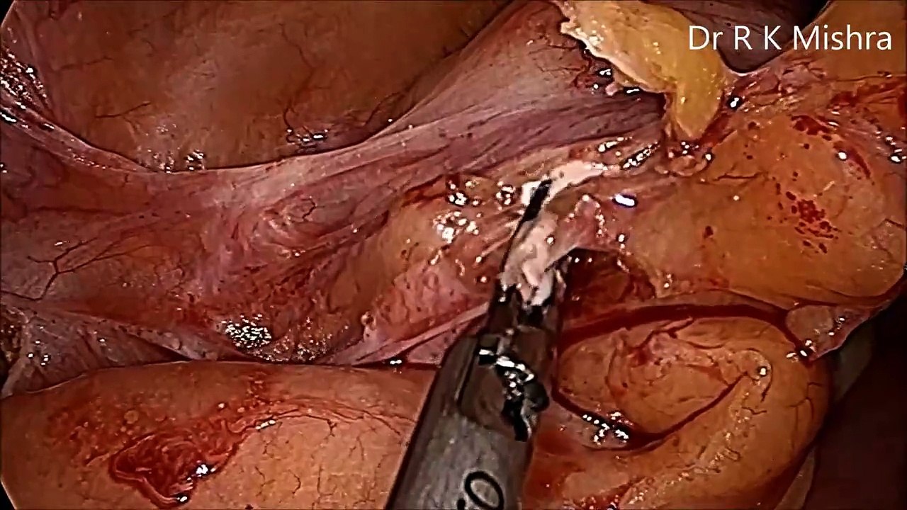 Laparoscopic Appendectomy for Fecalith of Appendix