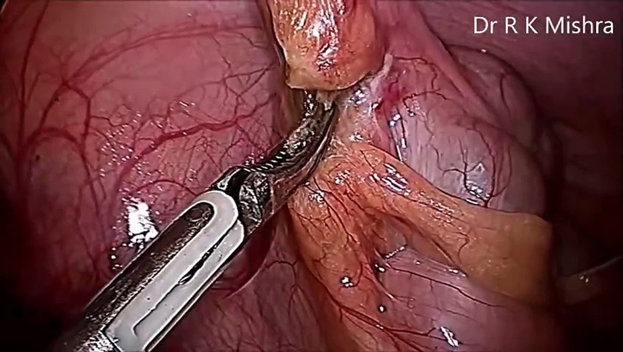 Laparoscopic Appendectomy Surgery Video