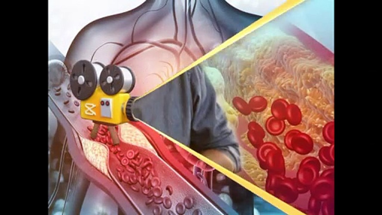 high cholesterol homeopathic medicine | cholesterol and triglycerides kaise kam kare homeopathic medicine