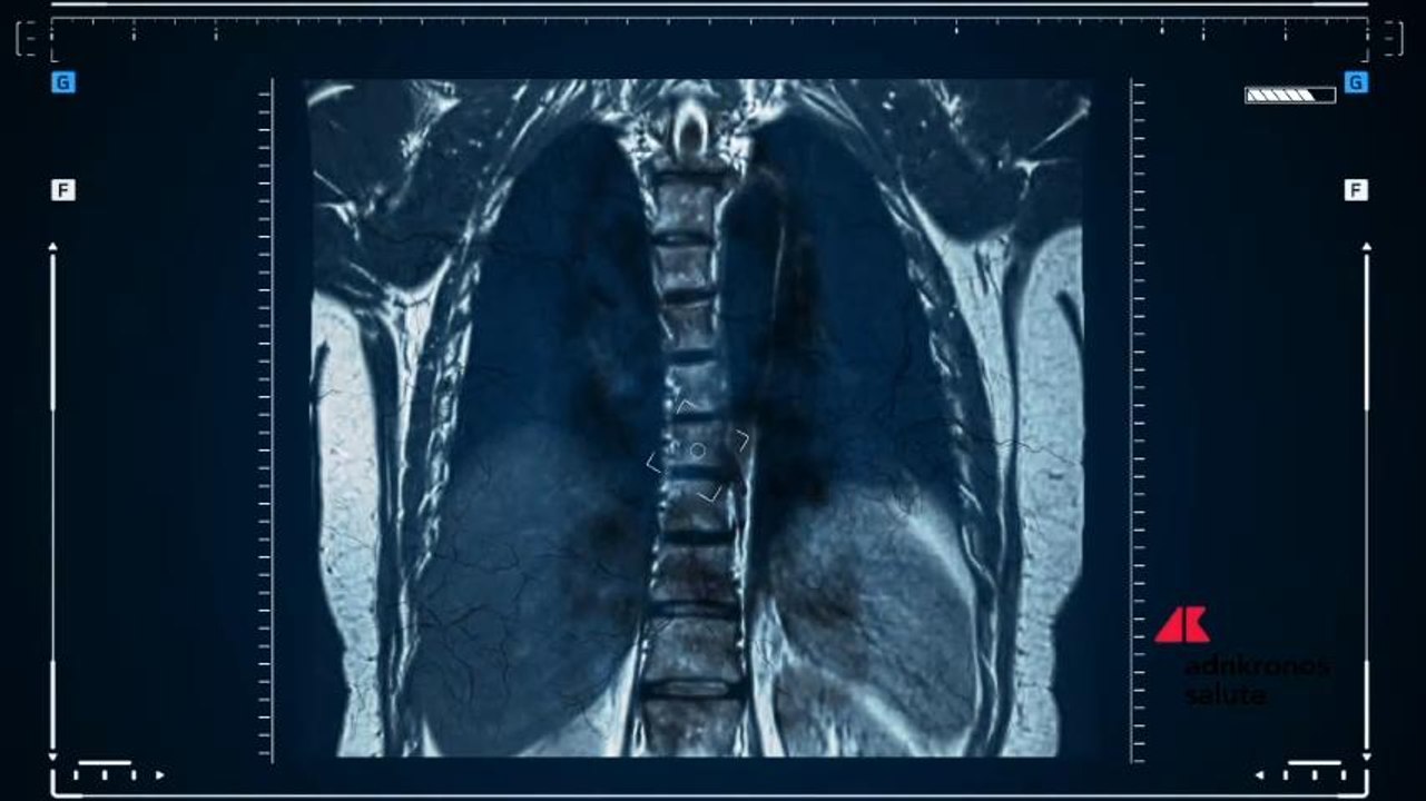 Congresso Sirm: grazie alle radiomica diagnosi oncologiche precoci