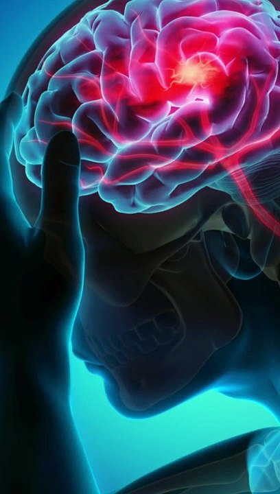 5 cara kenali stroke-20240624-WA0094