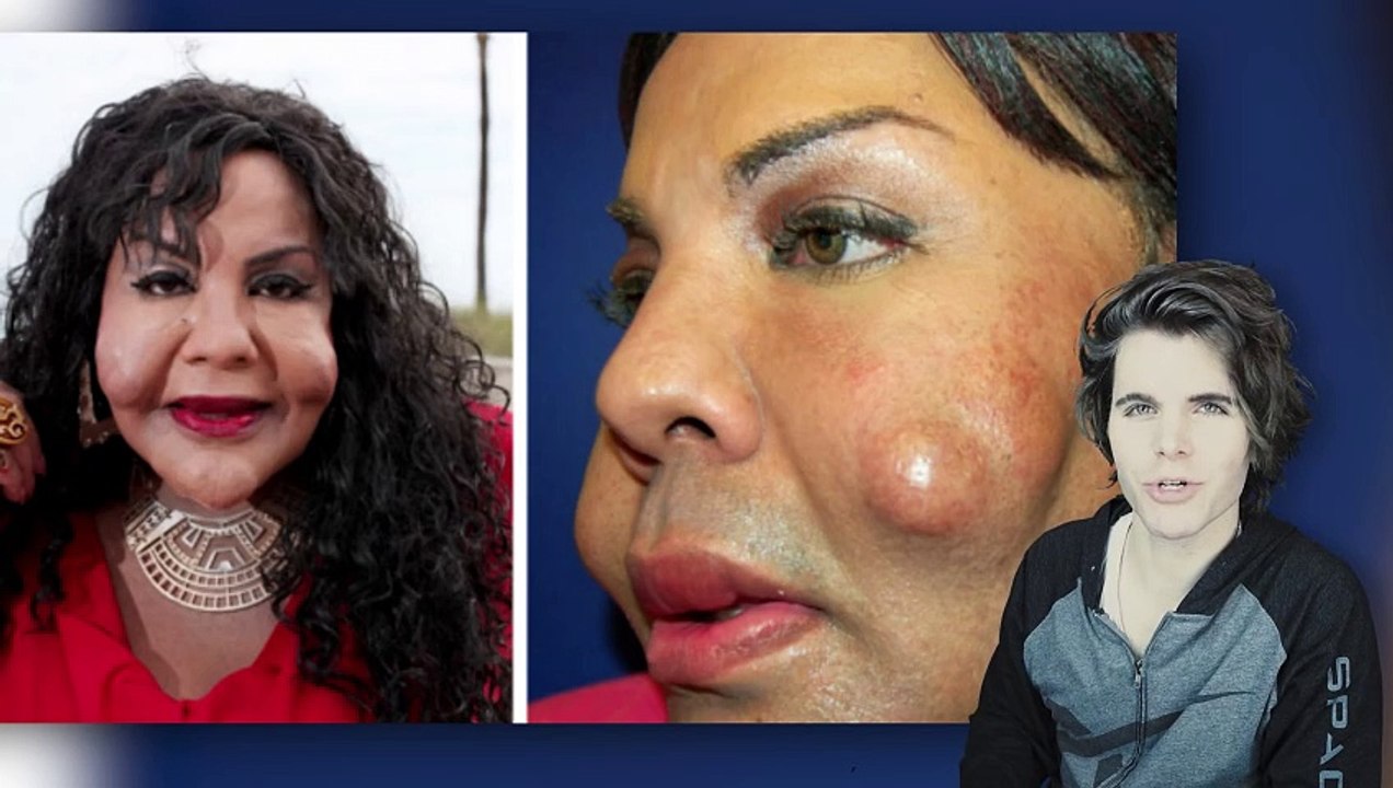 Face Implants Gone Wrong (Facelifts Before and After)